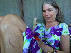 Vicki's burned leg